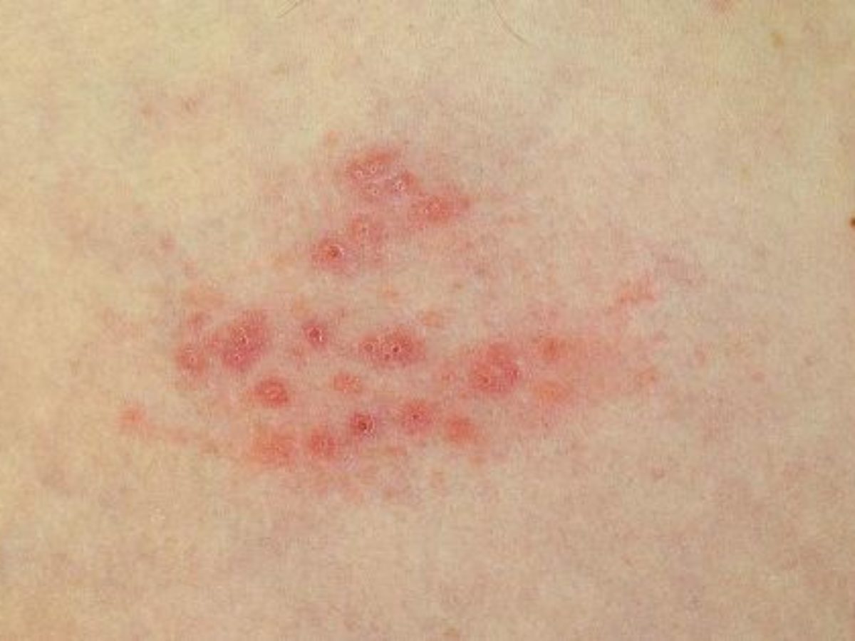 övsömör hidup helminthosporium turcicum)