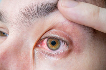 szem, allergia, kötőhártya gyulladás