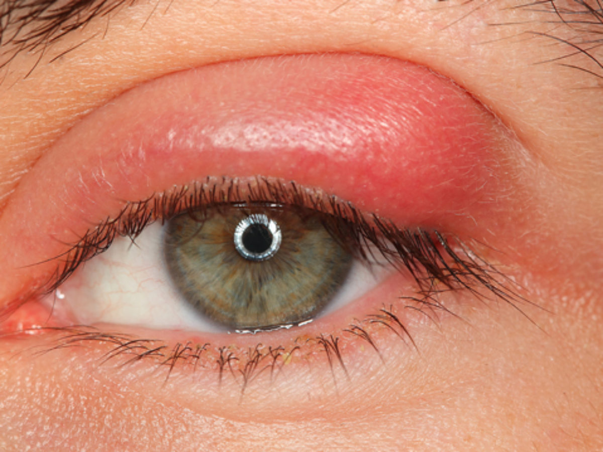 Vörös szem - mikor kell szemészhez fordulni?