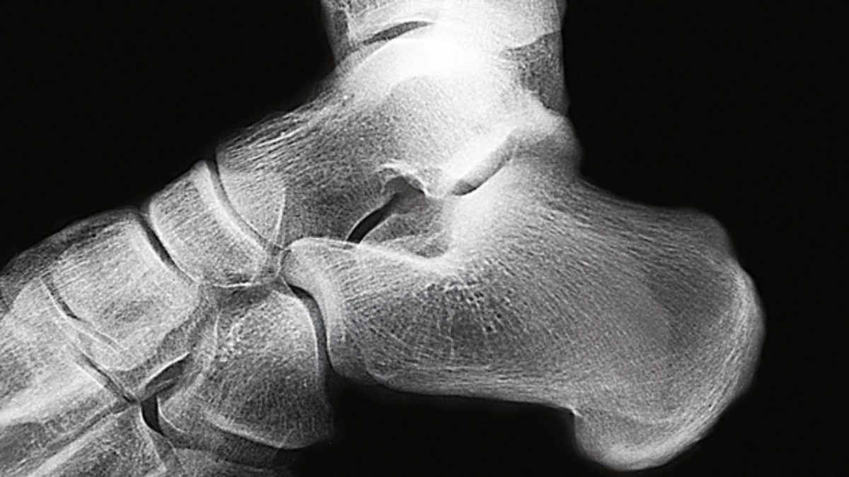artritisz sarok hogyan kell kezelni földízület kezelése