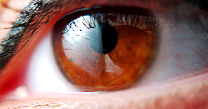 glaukóma látási problémák