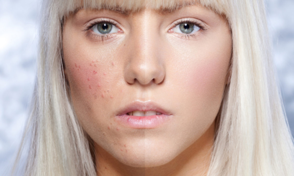 Hogyan lehet eltávolítani a vörös száraz foltokat az arcon. Bőrtünetek otthoni differenciálása