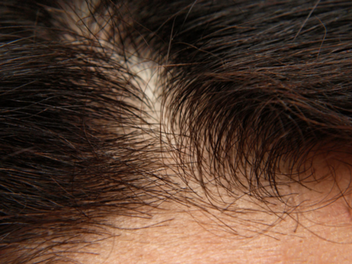A diffúz hajhullás okai és kezelése