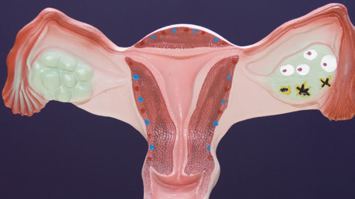 Laparoszkópos petefészek ciszta eltávolítás (Cystectomia ovarii)