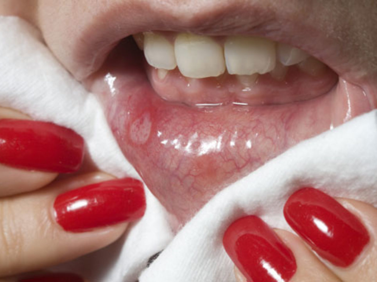 száj- és nail tünetek kezelés