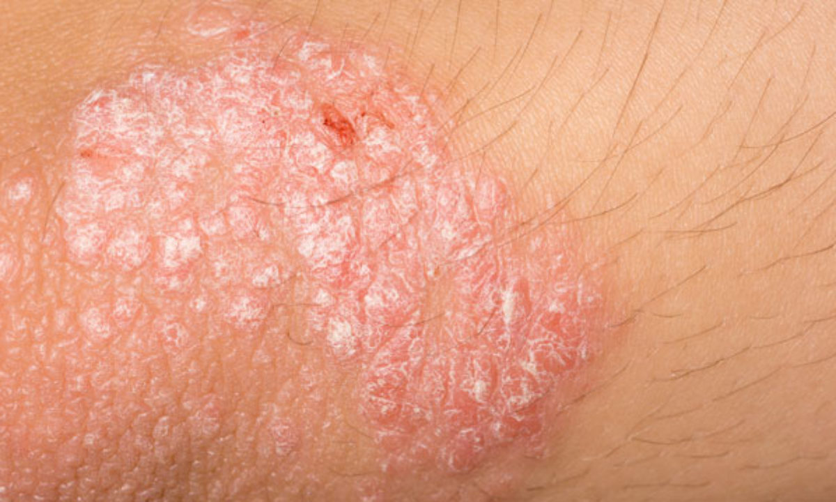 kiütés a hason vörös foltok formájában hónalj bőrét vörös foltok borítják