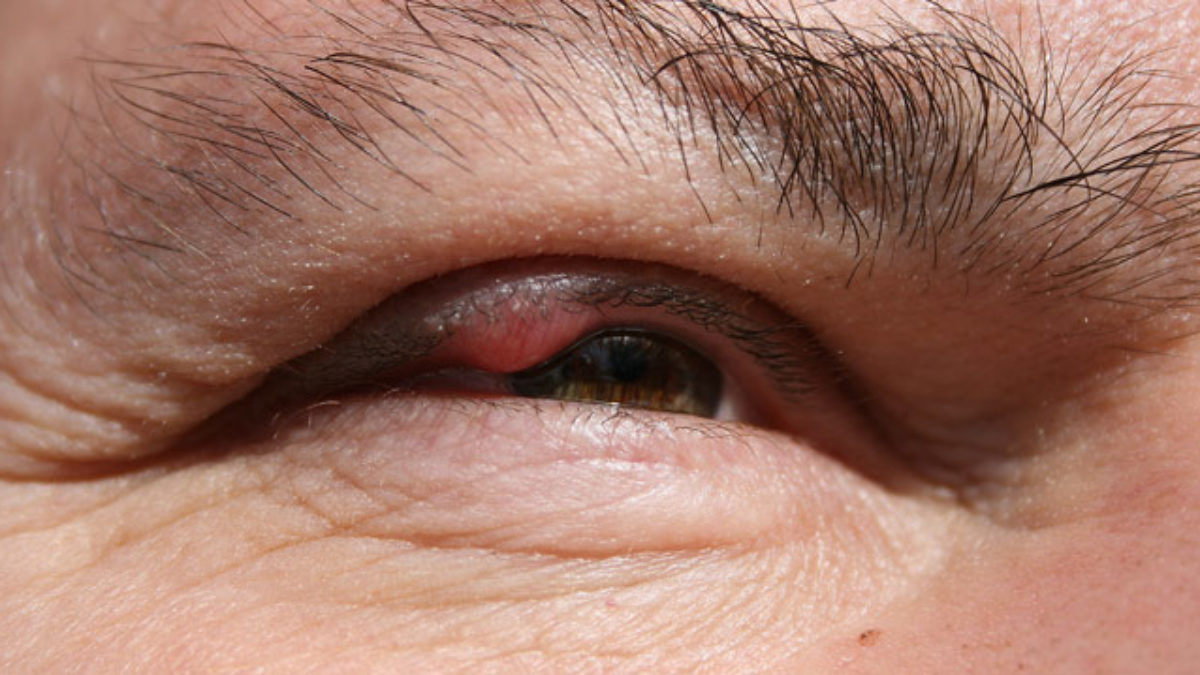 valami zavarja az egyik szem látását javítsa a látást egy ideig