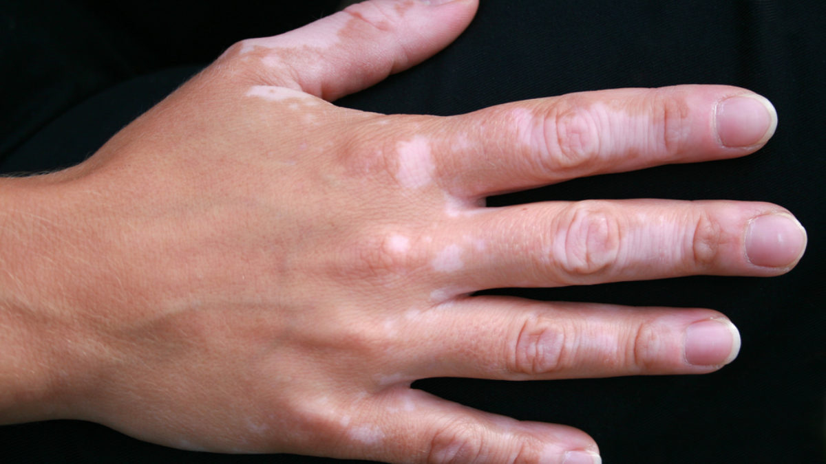 Titokzatos bőrbetegség - A vitiligo tünetei