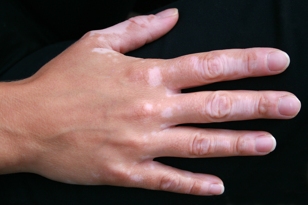 vitiligo nevű bőrbetegség