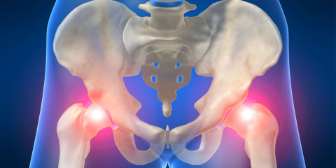A bal csípőízület csontritkulása. Nőknél gyakoribb