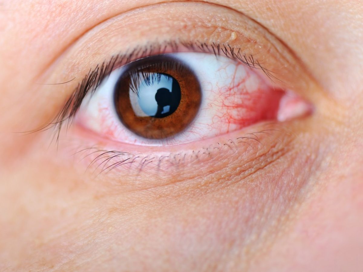 A száraz szem tünetei, okai és kivizsgálása