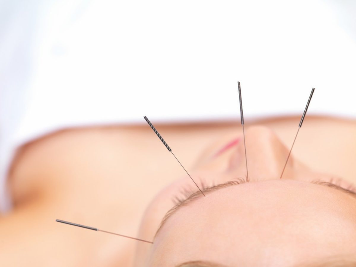 alagút szindróma akupunktúra nyaki gerinc kezelése