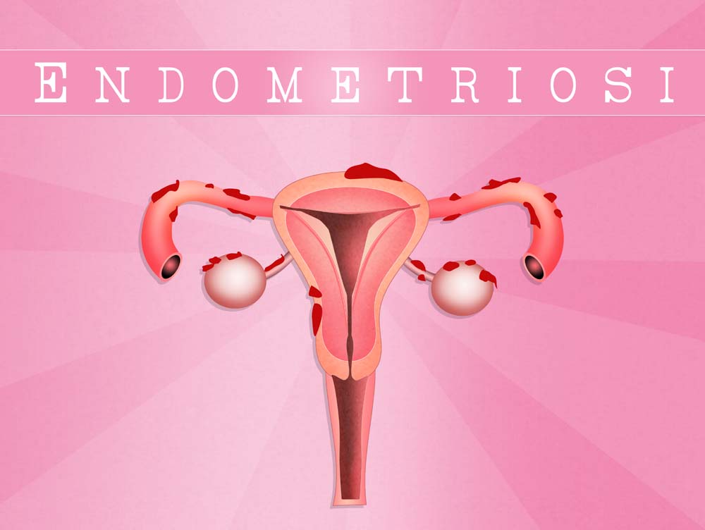 Diafragmatikus endometriózis