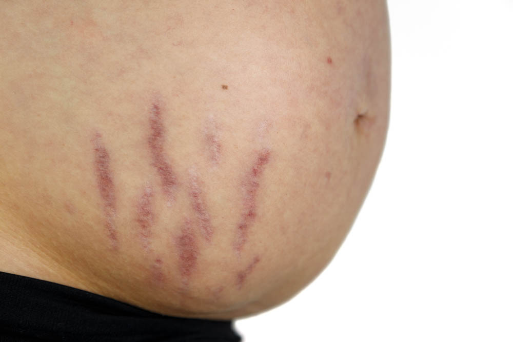 Babé hízási, fogyási és terhességi csíkok elleni krém ml