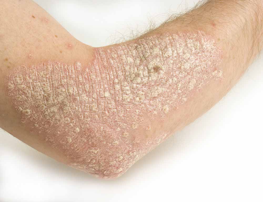 hogyan kell kezelni az orr vörös foltjait eczema or psoriasis on feet