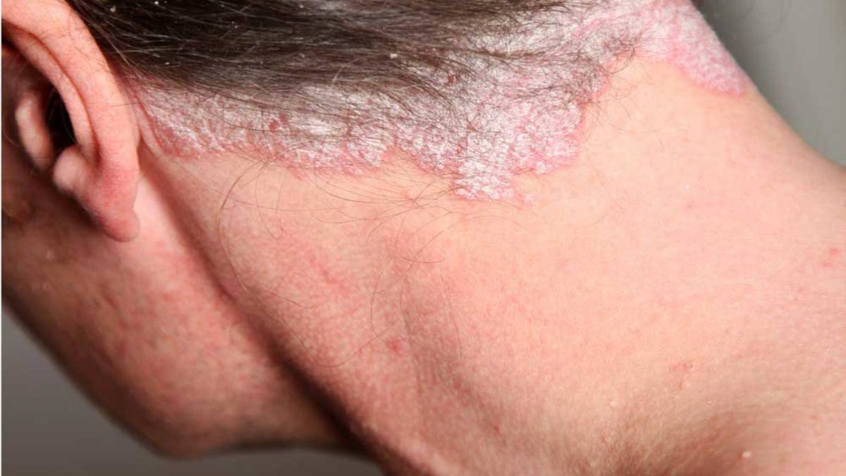 Mikor jelezhet betegséget a viszkető fejbőr? - EgészségKalauz