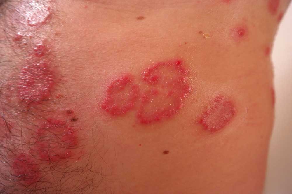 papilloma pikkelyes amygdala condyloma vektorok
