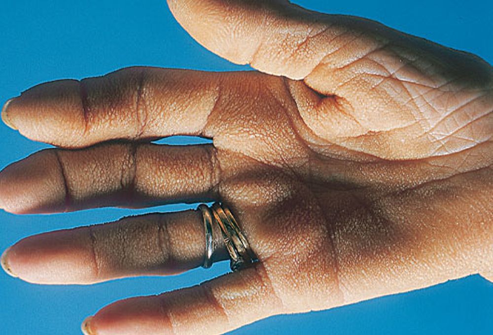 Szimpatika – A betegségek lelki háttere, Sírós bőrkeményedés az ujjak között