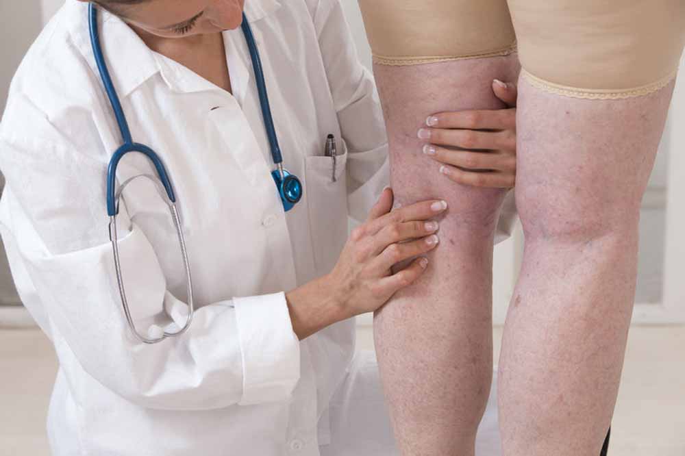 visszér attól ami előfordul a varikózis oka a nőknél a lábakon