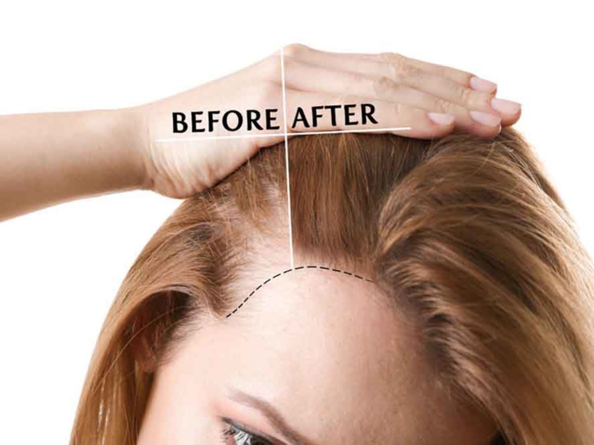 A diffúz hajhullás okai és kezelése