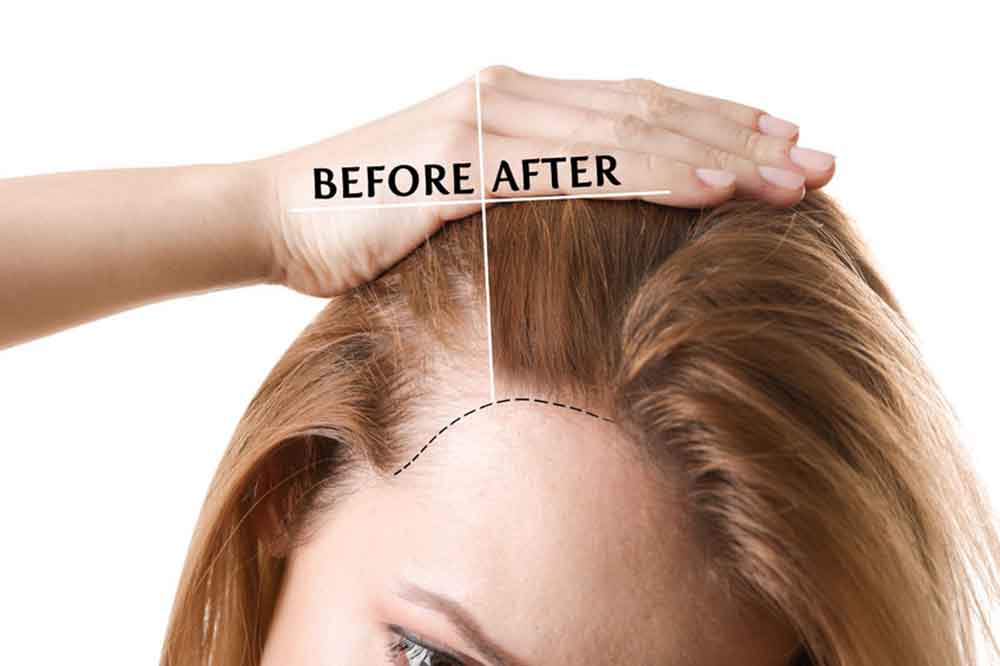 A hajhullás gyakoribb típusai, okai és kezelése