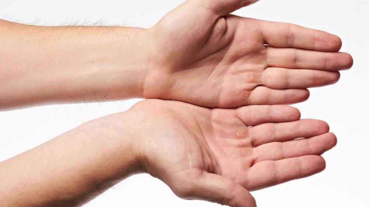 mi lehetetlen az ujjak artritiszével a fogyókúrás termékek hatékonysága