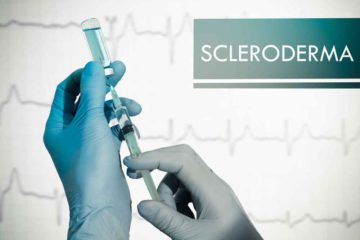 szkleroderma, scleroderma