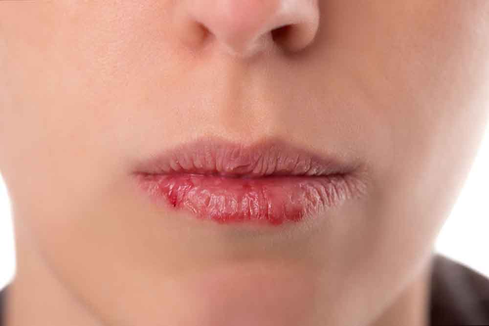 Az ajkak zsibbadása Fogyás és kék ajkak