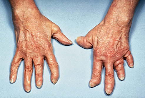 Artropátia – Wikipédia