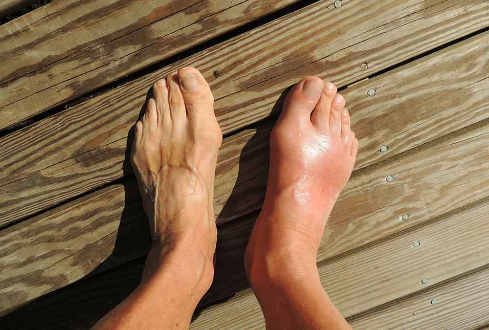 hogyan enyhíthető a nagy lábujj ízületi fájdalma