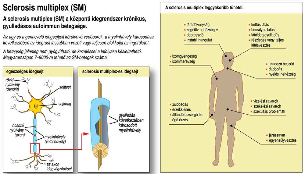 Sclerosis multiplexes férgek kezelése - Sclerosis multiplex vagy paraziták