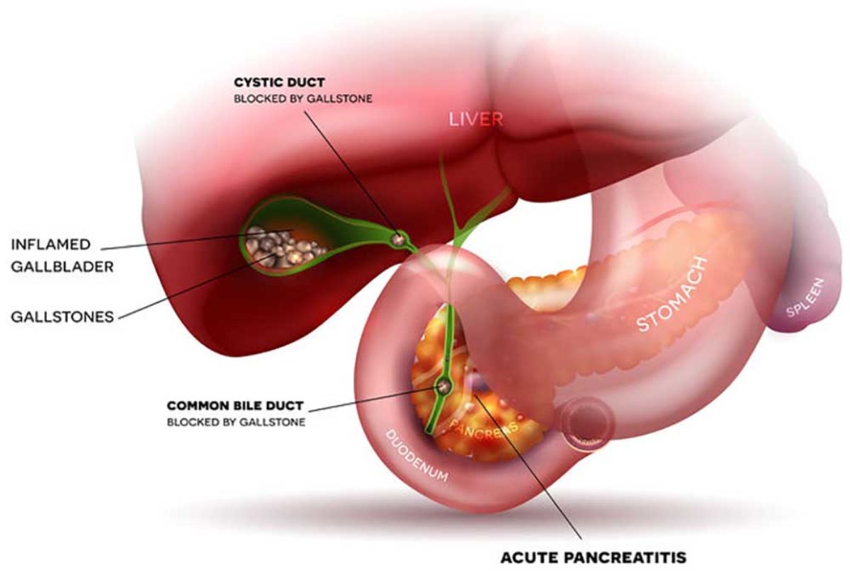 pancreatitis diétája)